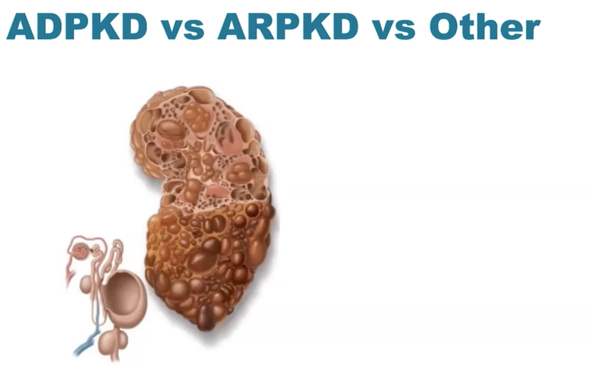 Shared Decision-Making in ADPKD / Available Treatment Options